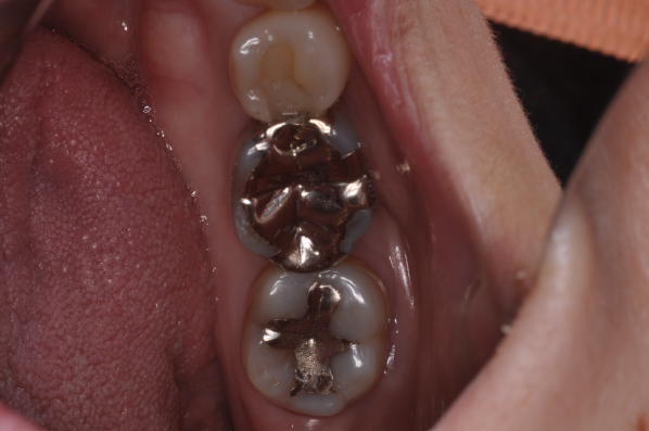 ジルコニアインレー