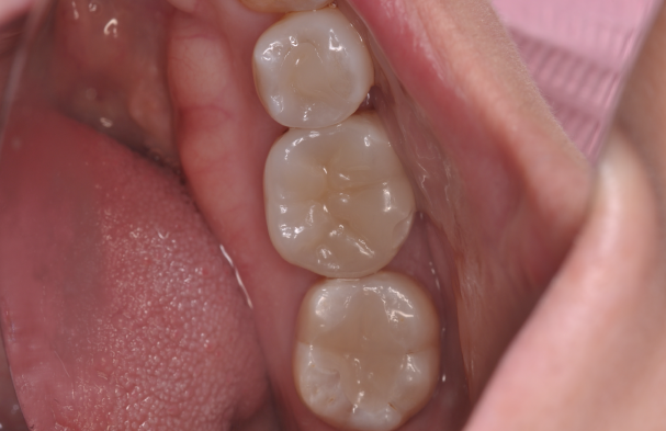 ジルコニアインレー治療後