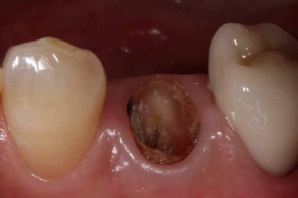 エクストルージョン①