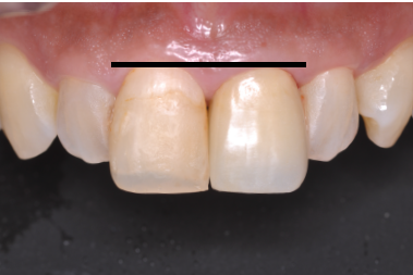 歯肉ライン一致