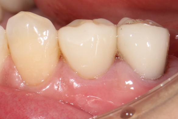 エクストルージョン④