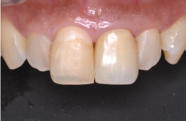 オールセラミックSET時