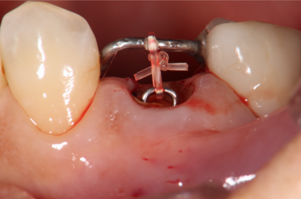 エクストルージョン②