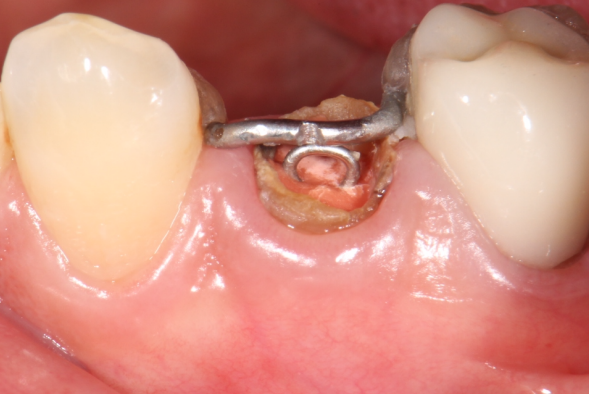 エクストルージョン③